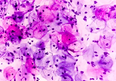 Microscopy view of cancerous human cervix cells stained violet. Microscopy view of cancerous human cervix cells stained violet.